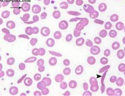 <p>what hemoglobinopathy is this?</p>