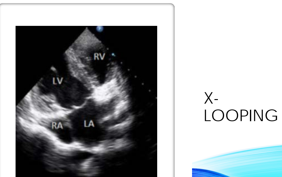 <p>VENTRICULAR LOOPING</p><p>(x-Loop) what about the looping?</p>