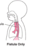 <p>tracheoesophageal fistula </p>