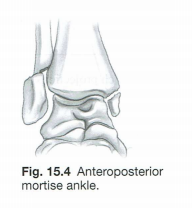 <p>A. Which specific named fracture does Fig. 15.4 illustrate? Which bone(s) is (are) commonly fractured with this type of fracture?</p>