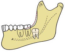 <p>often most complex</p><p>tooth completely encased in bone</p><p>requires <span style="color: red;">extensive bone removal + almost always sectioning</span></p>