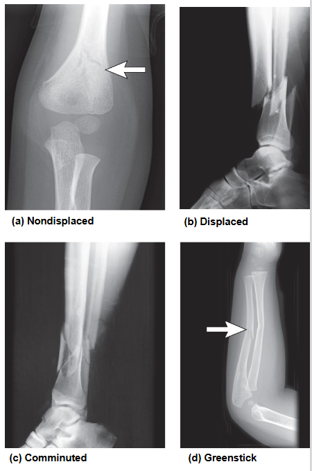 <p>Stress fracture</p>
