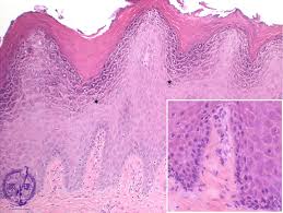 <p>What is the microscopic finding in the second finding?</p>