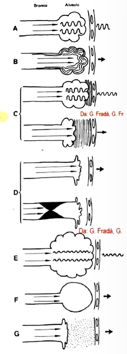 <p><span>• </span><strong><span>Soffi laringei ("Cornage"):</span></strong><span> Stridente, prolungato, inspiratorio, spesso con tirage soprasternale. Causa: Stenosi tracheale o dei grossi bronchi (ostruzione vie aeree superiori).</span></p><p><span>• </span><strong><span>Soffi bronchiali (passaggio d’aria bronchi):</span></strong></p><p><span>• Aspri (origine parenchimale): Aspro (polmoniti, tumori, broncopolmoniti); Aspro e rude (interstiziopatie con sclerosi/fibrosi). Varianti:</span></p><p><span>• Soffio tubarico: Simile a soffio in tubo vuoto, udibile in entrambe le fasi (più forte in inspirazione). Causa: Addensamento.</span></p><p><span>• Soffio anforico: Suono metallico. Causa: Cavità aerea nel parenchima comunicante coi bronchi o pneumotorace.</span></p><p><span>• Dolci (origine pleurica): Intensità debole, suono velato. Causa: Versamento pleurico moderato (non massivo/cospicuo).</span></p><p><span>• </span><strong><span>Soffi bronchiolari (Sibili):</span></strong><span> Tonalità sibilante. Cause: Stenosi piccole vie aeree per contrazione (ostruzione), infiammazione (bronchite asmatica) o secrezioni.</span></p><p><span>• </span><strong><span>Correlazioni anatomopatologiche all'auscultazione:</span></strong></p><p><span>• Versamento modesto ("a camicia"): Diminuzione del murmure.</span></p><p><span>• Atelettasia: Se bronco pervio -> soffio bronchiale. Se bronco ostruito -> </span><strong><span>silenzio respiratorio</span></strong><span>.</span></p><p><span>• Enfisema polmonare: Murmure diminuito (riduzione setti alveolari).</span></p>