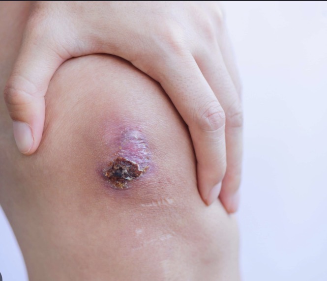 <ul><li><p>Layer of thick, necrotic tissue that forms over tissue</p></li><li><p>Scab tissue </p></li></ul><p></p>