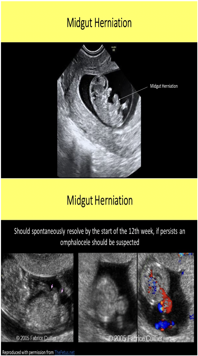 <p>C. 12wks</p><p>Herniation of the midgut begins at week 8 and retraction occurs by week 12 in a normal gestation.</p>