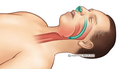 <p>nasopharyngeal airway (NPA)</p>