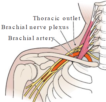 <p><strong>Definition</strong></p><ul><li><p>Disorder of fingers, hand, wrist due to compression of brachial nerve plexus and vesels between neck and shoulder</p></li></ul><p></p><p><strong>Causes</strong></p><ul><li><p>Tilting head forward, hunching, reaching overhead </p></li></ul><p></p><p><strong>Symptoms</strong></p><ul><li><p>Numb, tingle, pain in fingers, hands, wrists</p></li></ul><p></p>