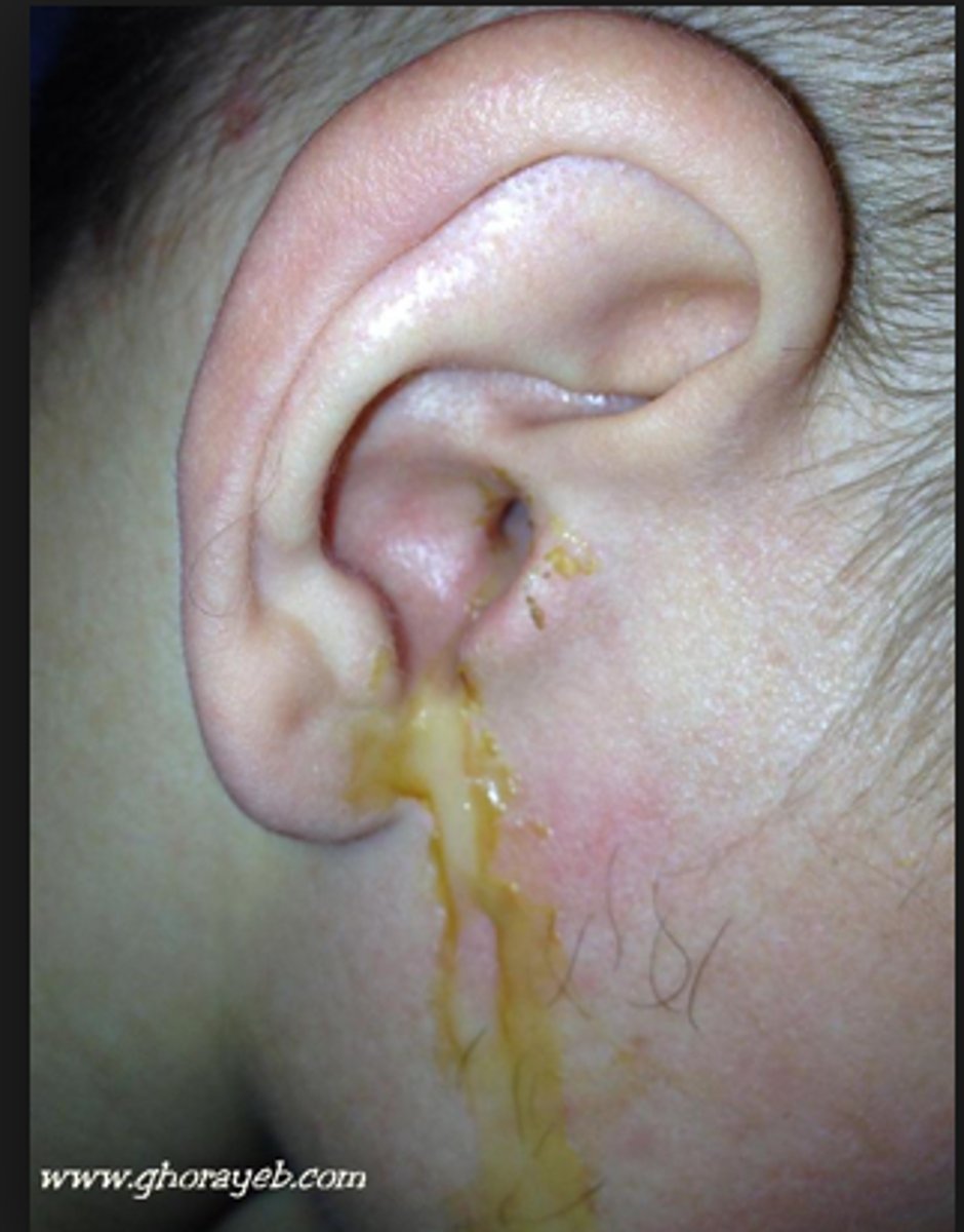 <p>is discharge coming out of the ear (s). It can consist of mucus, pus, blood, or cerebrospinal fluid.</p>