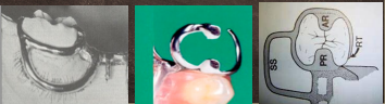 <p>What type of Circumferential clasp/suprabulge is shown</p>