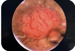 <p>Which type of epithelial tumor is shown in this image?</p>