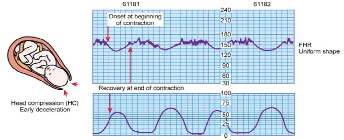 <p>slowing of FHR at the start of a contraction and returns to baseline at the end of contraction</p>