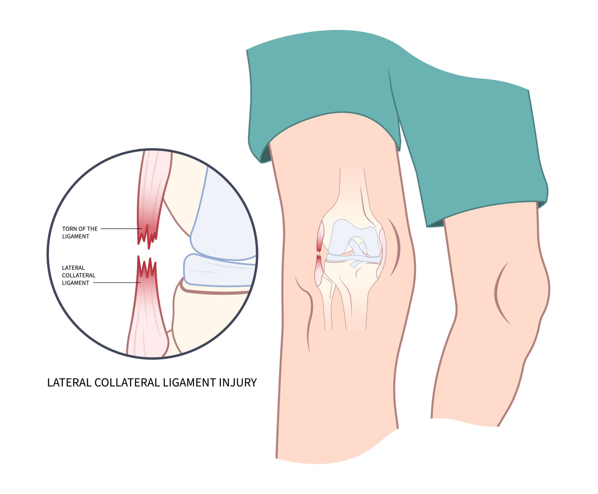 <p>Primary lateral stabilizer; part of the lateral release sequence in a valgus knee.</p>