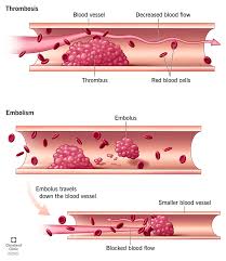 <p>What is a thrombus?</p>