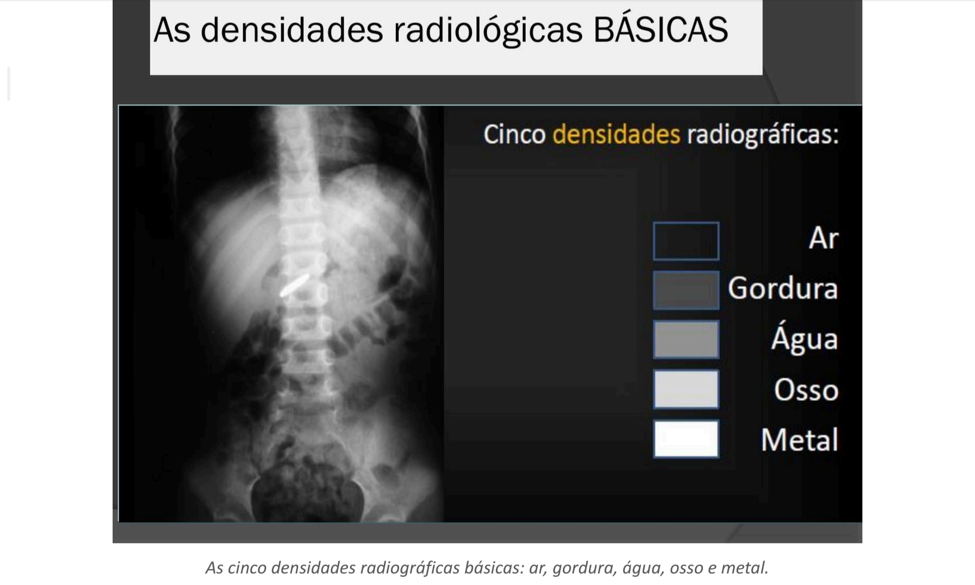 <p>Quais exemplos clínicos correspondem a cada densidade radiológica?</p>
