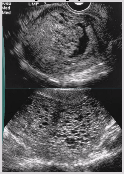 <ul><li><p><span style="background-color: transparent;">Endometrial cavity filled with heterogeneous echogenic material&nbsp;</span></p></li><li><p><span style="background-color: transparent;">Vesicular appearance - multiple cysts</span></p></li><li><p><span style="background-color: transparent;">Increased UT size&nbsp;</span></p></li><li><p><span style="background-color: transparent;">Fluid collection around molar mass&nbsp;</span></p></li><li><p><span style="background-color: transparent;">Mimics appearance of degenerating myoma</span></p></li></ul><p></p>