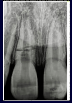 <p>-the more apical the fracture, the better the prognosis</p><p>-more apical means being more walled-off from the oral environment</p><p>-apical segment: blood supply maintained, never a problem</p><p>-coronal segment at risk: mobility, splint required for 4 weeks, RCT not needed (just observe)</p><p>-when coronal pulp necroses, see if you can reposition the segment and splint, or can do RCT on the coronal segment only</p><p>-if apical segment starts trouble, just do apicoectomy to treat</p>