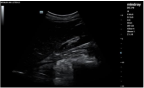 <p>If the entire ultrasound image appears too dark, what adjustment should be made FIRST?</p><p>a) Increase output power</p><p>b) Increase overall gain</p><p>c) Increase imaging depth</p><p>d) Increase dynamic range</p>