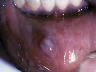 <p>Mucous retention cysts</p>