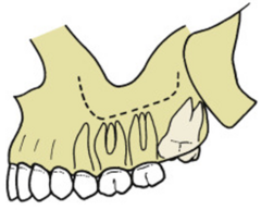 <p>ID the angulation classification of the impacted 3rd molar:</p>