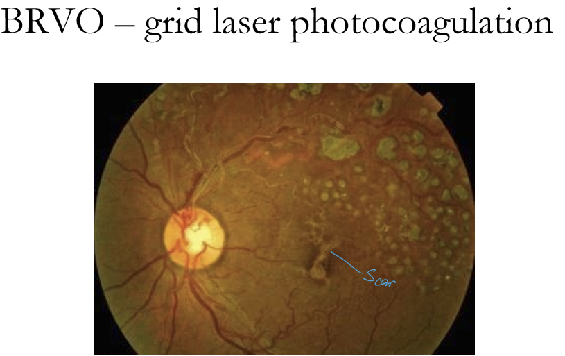 <p>Grid laser helps macular edema mildly after branch vein occlusion according Branch Vein occlusion Study (BVOS). </p>