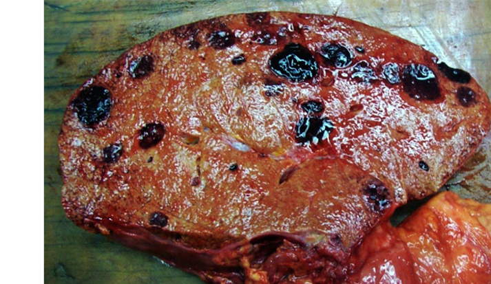 <p>multicentric hemorrhagic nodules</p>