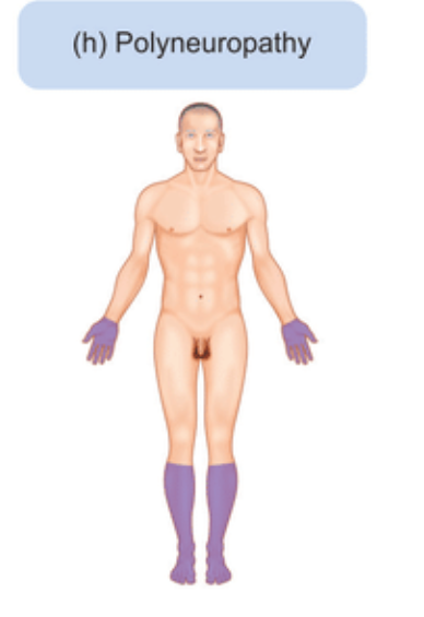 <p><span>Typically causes symmetrical sensory deficits in a āglove and stockingā distribution in the peripheral limbs. The most common causes of peripheral neuropathy are diabetes mellitus and chronic alcohol excess.</span></p>