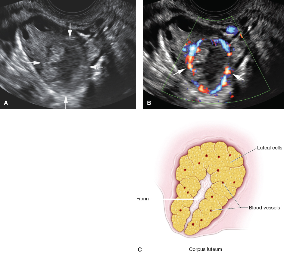 <p>literally interpreted “yellow body,” primarily produces progesterone to maintain the thickness of the endometrium and prepares the endometrium for the (conceivably) fertilized ovum. All the other follicles undergo atresia.</p>
