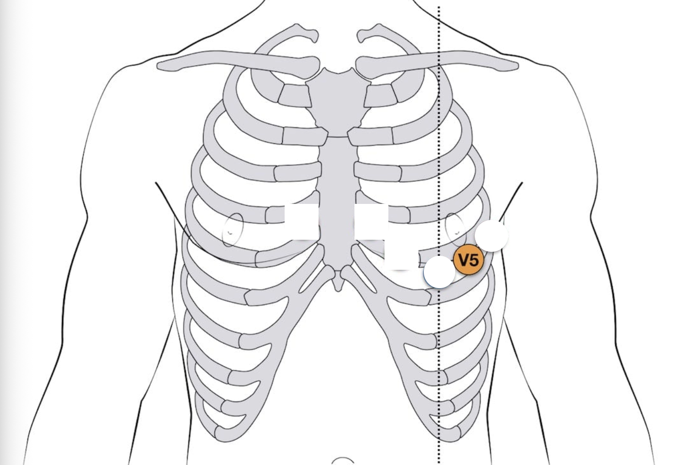 <p>V5 placement - 12-lead EKG</p>