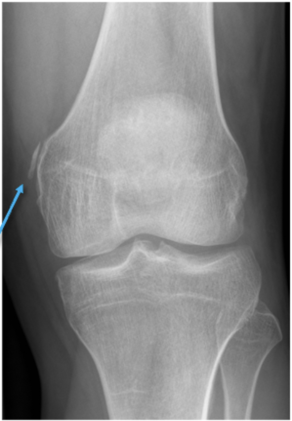 <p>What can be observed in this image and what structure is being affected? What is this indicative of?</p>
