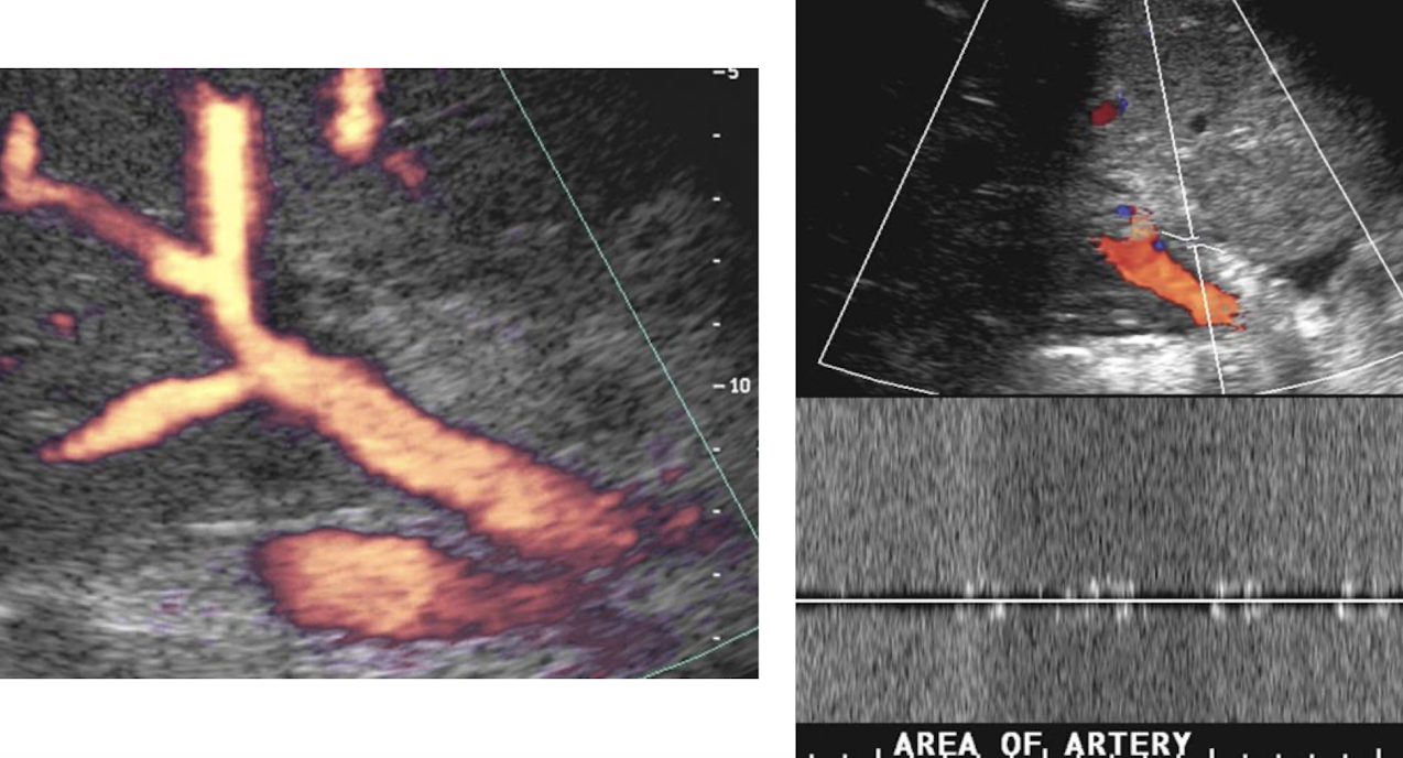 <ul><li><p>turn up PW gain to see noise</p></li><li><p>should confirm no flow to prove HA thrombosis </p></li></ul><p></p>