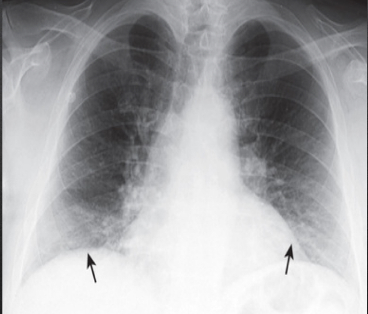 <ul><li><p>compress and crowd the lung markings at the llung bases adn diaphram</p></li><li><p>could be misleading of pneumonia or cardiomegaly </p></li><li><p>only 7 posterior ribs visible </p></li></ul><p></p>