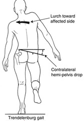 <p>RT SIDE IS EFFECTED</p><p>RT GLUTE MEDIUS </p><p>NOTE ITS ALWAYS THE OPPOSITE OF THE LEG THAT DROPS - the other side has to be able to stabilize the hips when standing on just one leg so if theres a drop on the other side while standing on x leg. then X side is the side that is weak, not the side thats elevated bc the muscle is suspended in the air if you think about it so it cant do anything.</p>