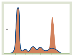 <ul><li><p><span style="background-color: transparent; font-family: "Times New Roman", serif;">The Pattern: A tall, narrow, </span><span style="font-family: "Times New Roman", serif;">"church-spire" peak in the Gamma region</span><span style="background-color: transparent; font-family: "Times New Roman", serif;">.</span></p></li><li><p><span style="background-color: transparent; font-family: "Times New Roman", serif;">Why: This is a classic sign of </span><span style="font-family: "Times New Roman", serif;">Multiple Myeloma</span><span style="background-color: transparent; font-family: "Times New Roman", serif;">. A single clone of plasma cells is pumping out a massive amount of one specific, identical antibody; spike in IgG.</span></p></li></ul><p></p>