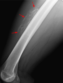 <p><span style="color: red;"><strong>Myositis Ossificans</strong></span></p>