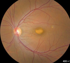 <p>- Inheritance pattern: AD</p><p>- Mutation: BEST1</p><p>- Age of onset: childhood</p><p>- Key findings: egg-yolk lesion at macula</p><p>- Prognosis: good VA early, central vision declines as egg breaks up</p><p>*Normal ERG, abnormal EOG (<1.6)</p>