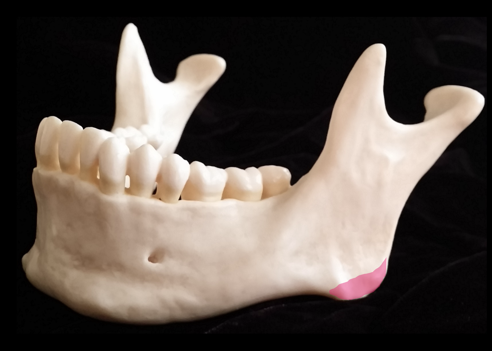 <p>What is the pink region highlighted on the mandible?</p>