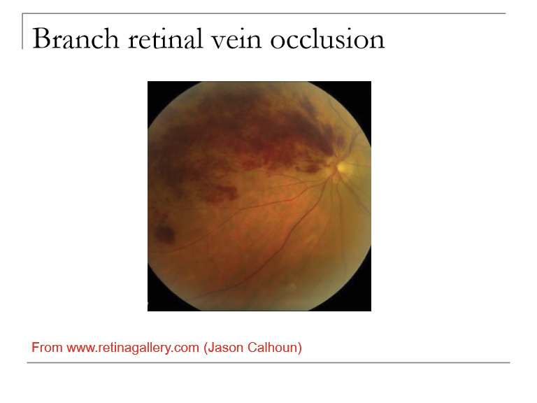 <ul><li><p>Hypoxia with potential for retinal neovascularization (~8% of BRVO patients develop retinal neovascularization which may be hidden by hemorrhage)</p></li><li><p>Microaneurysms appear, can leak, creating retinal edema which can include macular edema </p></li></ul><p></p>