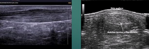<ul><li><p><span style="background-color: transparent;">LAX </span></p><ul><li><p><span style="background-color: transparent;">Linear band of hyperechoic strands and fibrillar pattern, interspersed with relatively hypoechoic connective tissue</span></p></li></ul></li><li><p><span style="background-color: transparent;">SAX </span></p><ul><li><p><span style="background-color: transparent;">“Whisk-broom” appearance </span></p></li><li><p><span style="background-color: transparent;">Hyperechoic foci throughout tendon distribution interspersed by hypoechoic connective tissue</span></p></li><li><p><span style="background-color: transparent;">Must maintain uniform thickness throughout except at site of insertion (might broaden)</span></p></li></ul></li></ul><p></p>