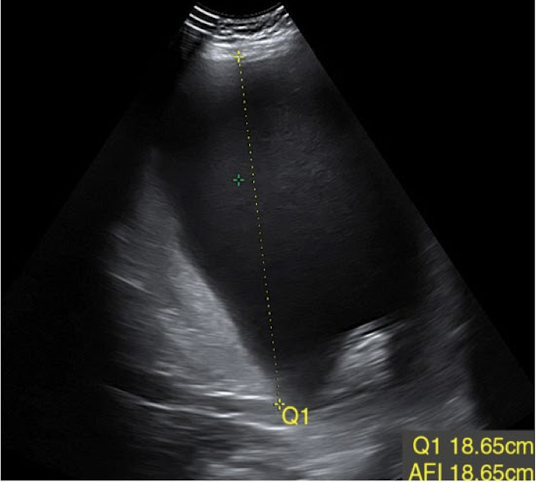 <ul><li><p>maximum vertical pocket assessment (MVP)</p></li><li><p><span style="color: red;">measure largest pocket in AP</span></p></li><li><p>pocket should be clear of fetal parts and umbilical cord</p></li></ul><p></p>