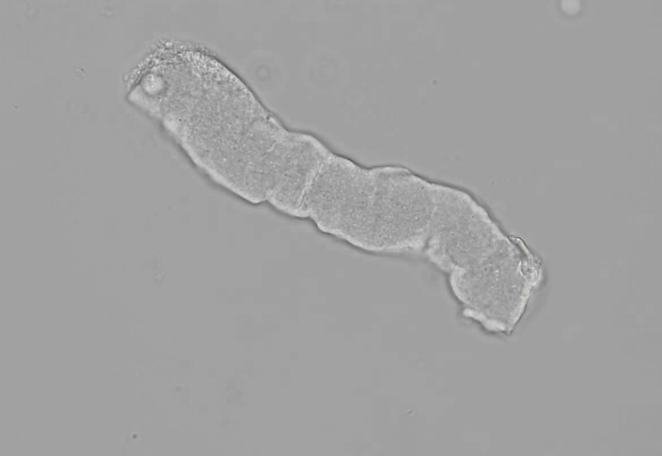 <p>They indicate extreme, localized urine stasis in the kidneys. They are most frequently associated with severe chronic renal disease and are often called "renal failure casts."</p>