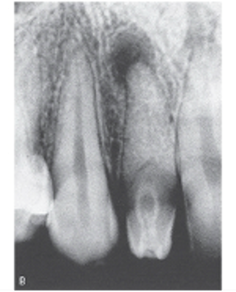 <p></p><p><br></p><p>-tooth within a tooth</p><p><br><span>The most common location for this developmental anomaly is the maxillary lateral. What is this anomaly called?</span></p>