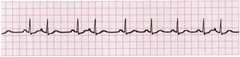 <p>- premature beat originating in the atria</p><p>- early P wave with a different morphology than the sinus P wave</p><p>- normal/narrow QRS</p><p>- followed by a brief, noncompensatory pause</p><p>- underlying rhythm may be regular</p>