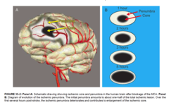 <p>What: Reduced blood flow to a specific part of the brain </p><p>Causes: Cerebral artery occlusion</p>