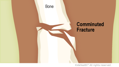 <p>comminuted </p>