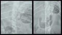 <p>Which one is the BEST positioned in terms of dorsal spinous processes?</p>