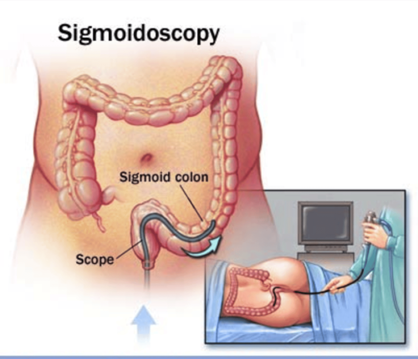 <p>sigmoidoscopy</p>
