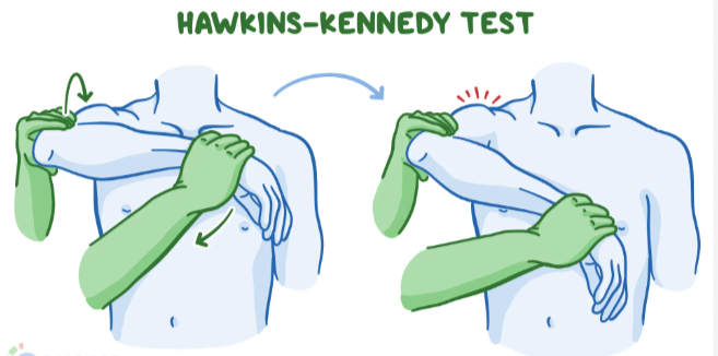 <p><strong>impingement syndrome</strong></p><p>have patient seated</p><p>stand behind them</p><p>bring their arm pointing in front of them then bend at elbow so blocking chin</p><p>stabilize top of shoulder</p><p>bring wrist down to ground</p><p>compare to other side</p><p>positive if: <span style="background-color: transparent;">limited</span> ROM and pain in shoulder</p>