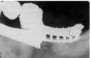 <p>Radiopaque artifact</p>