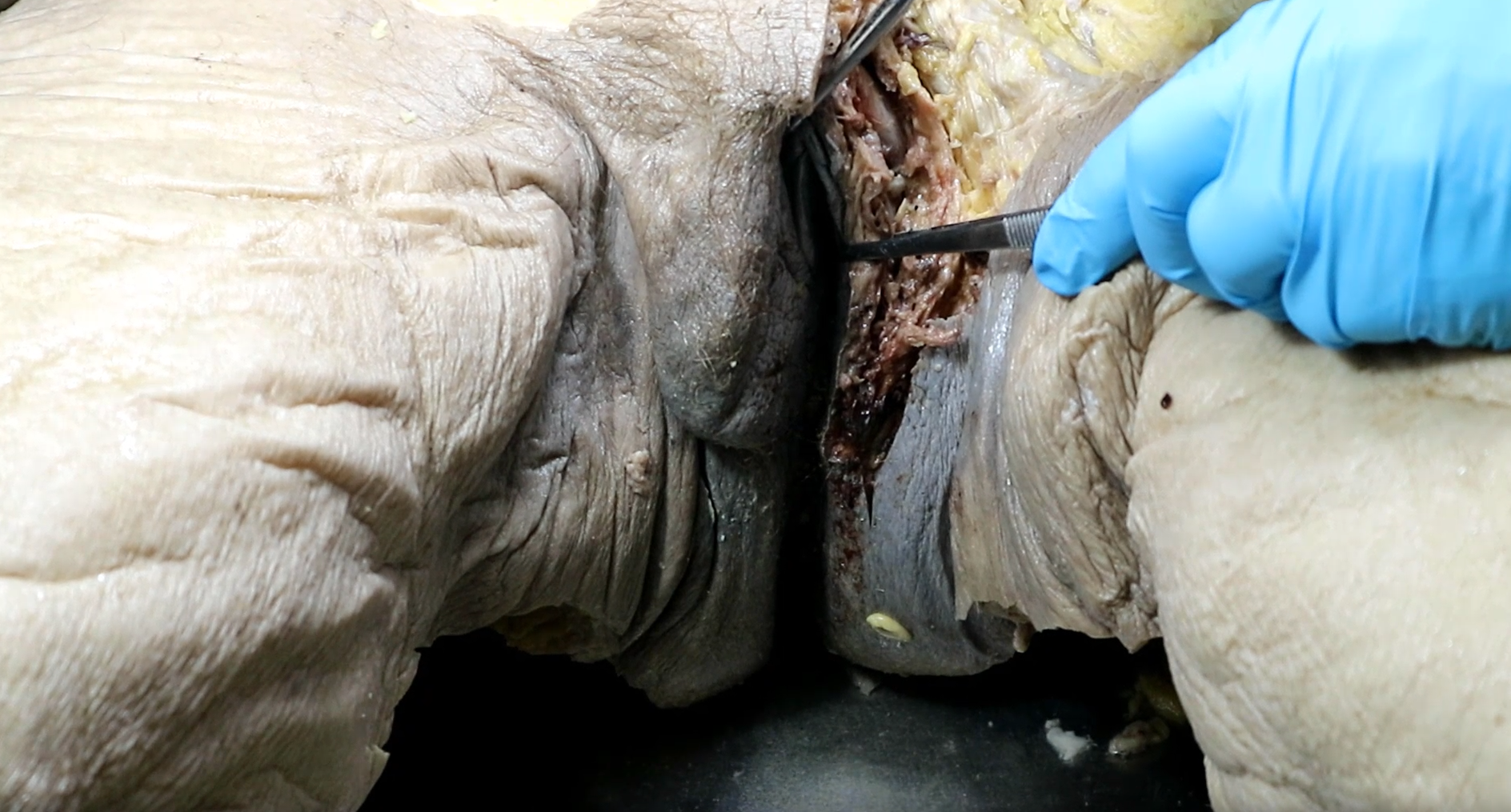 <p>entire area between forceps &amp; probe</p>